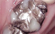 Estesa ricostruzione in amalgama di molare superiore gravemnete danneggiato