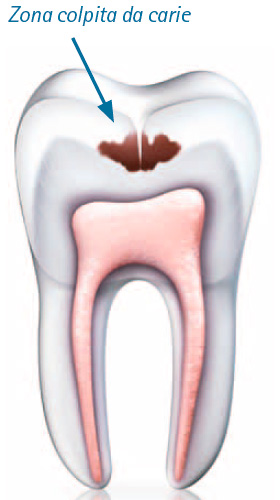 Zona colpita da carie