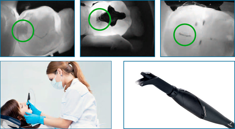 DIAGNOcam rileva la carie in modo rapido e sicuro