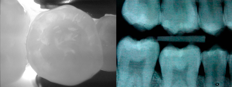 DIAGNOcam utilizza un raggio laser a diodi di tipo 1, sicuro al 100%