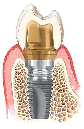 Impianto in titanio dopo il suo inserimento e protesizzazione