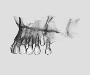 Ricostruzione 3D di impianto endoosseo all'arcata mascellare ottenuta con tc volumetrica a fascio conico