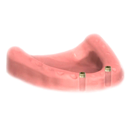 Rappresentazione grafica di impianti inseriti all'arcata dentaria inferiore a supporto di overdentures
