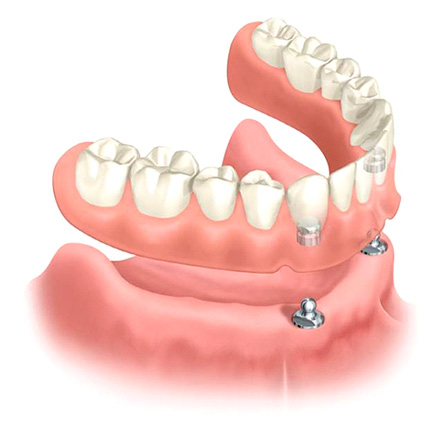 Rappresentazione grafica di overdentures all'arcata dentaria inferiore