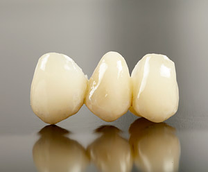 Ponte di 3 elementi estetico in zirconio per stratificazione