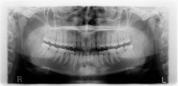 ortopantomografia digitalizzata