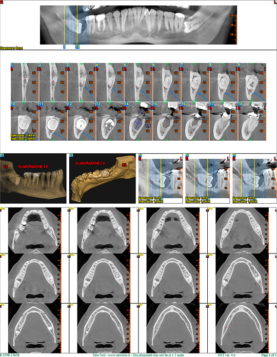 Elaborazione di TAC volumetrica arcate dentarie disponibile presso lo studio dentistico dott. Ometto