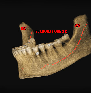 Ricostruzione arcata mandibolare per risaltare decorso e rapporti del nervo alveolare inferiore in previsione terapia estrattiva dente del giudizio