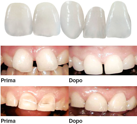 Faccette estetiche per la correzione di macchie e discolorazioni, per la correzione di disallineamenti dentari, per il ripristino di denti usurati nel rispetto dell'elemento dentario